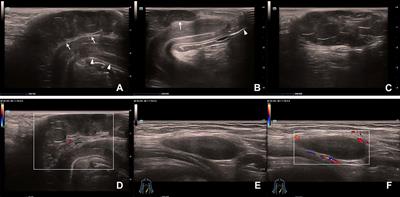 Case report and literature review: plexiform schwannoma in the penile and inguinal region in a child